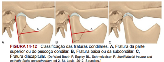 acidente maxilar e mandibula