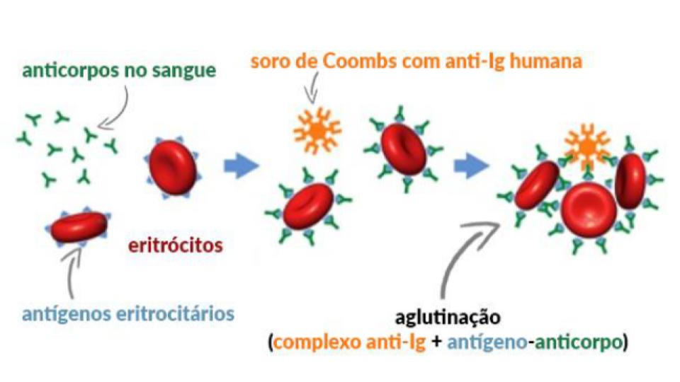 Diagrama do teste de Coombs indireto mostrando anticorpos se ligando a antígenos de eritrocitos e gerando aglutinação após adição de soro.